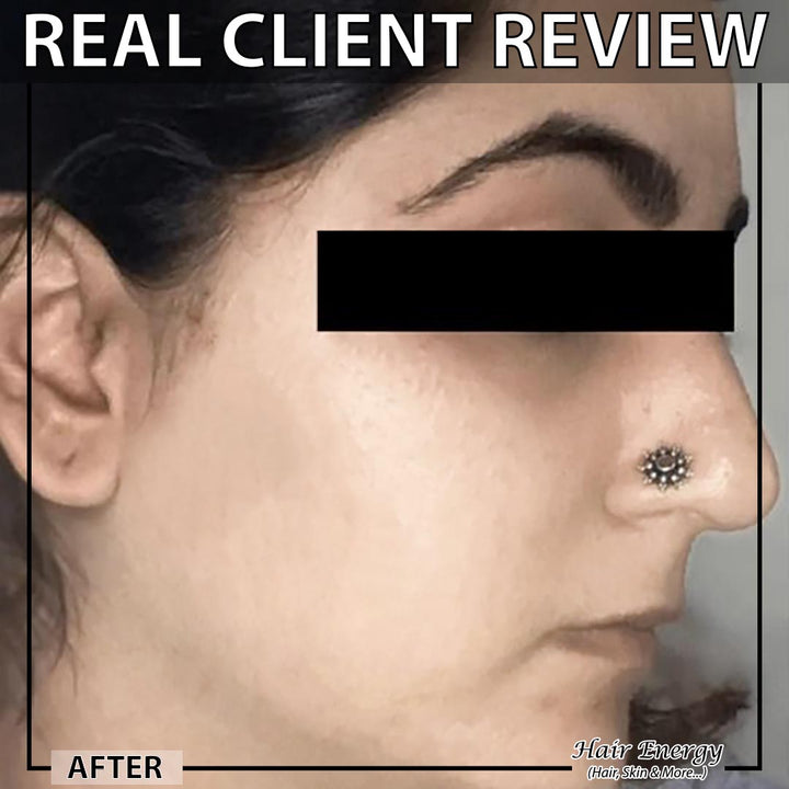 ANTI-ACNE SERUM (6860866420912)