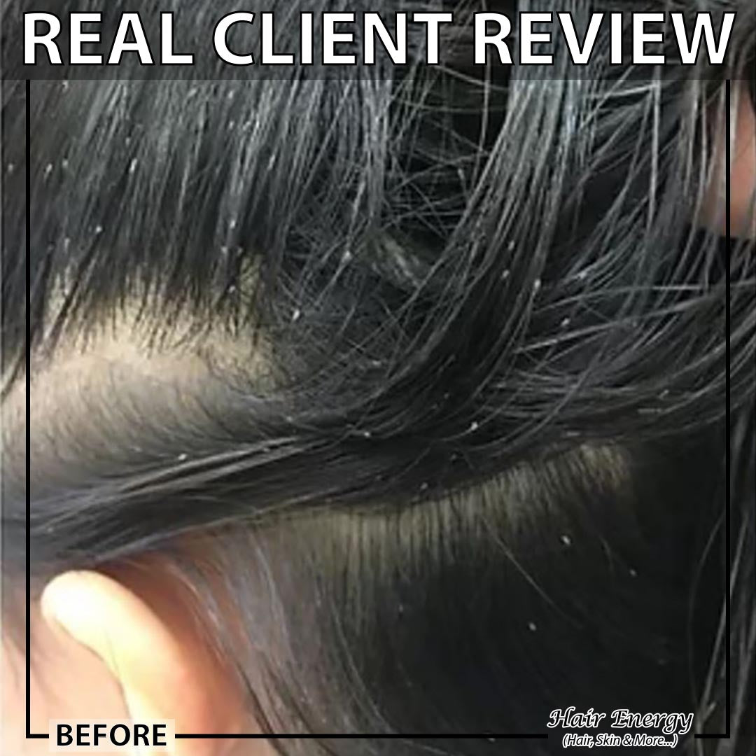 ANTILICE SHAMPOO with Herbal Extracts (Actual Price "935" After Dis