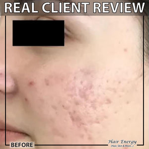Derma Roller 1mm